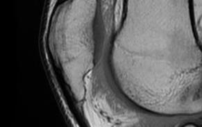 Patella Spur MRI